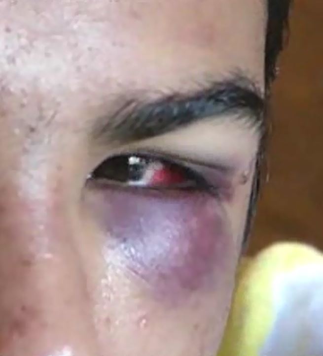 Christopher Perez applies an icepack to his savagely beaten face. The small teen with the mind of a 5-year-old was ruthlessly attacked by rogue Collier County deputies in December 2013. 2015 Naples Ninja News. All rights reserved